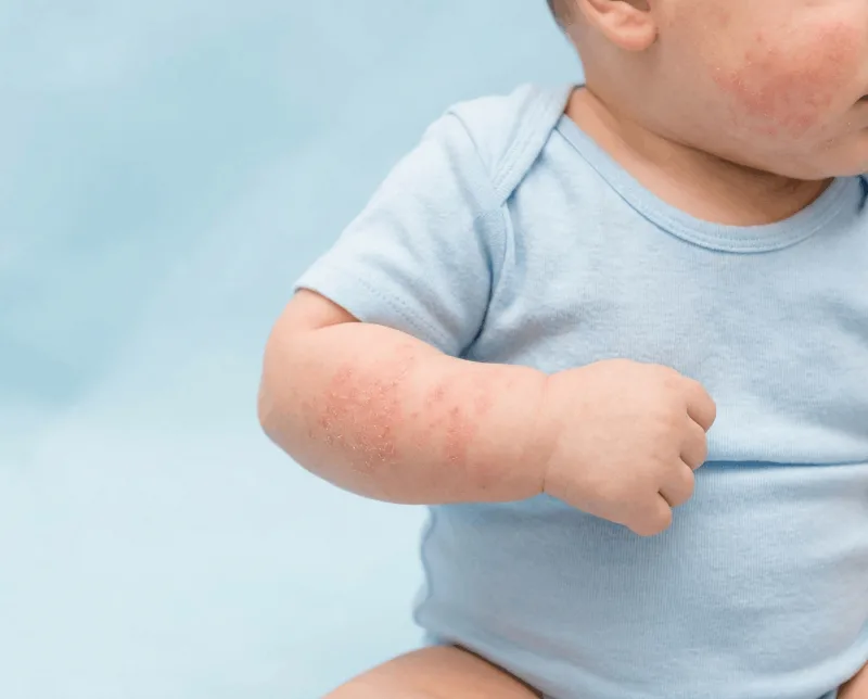 Atopični dermatitis pri otroku